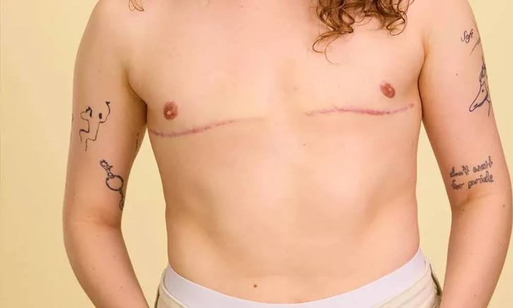 How FTM Top Surgery Supports Individual Gender Affirmation and Transition Goals